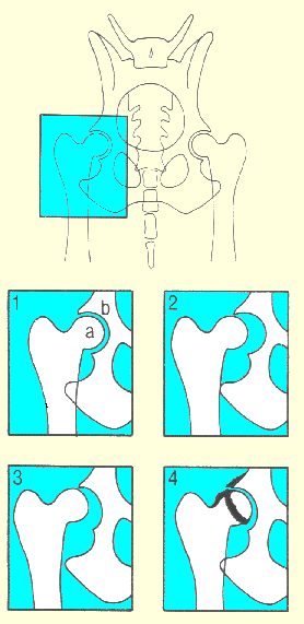 HD